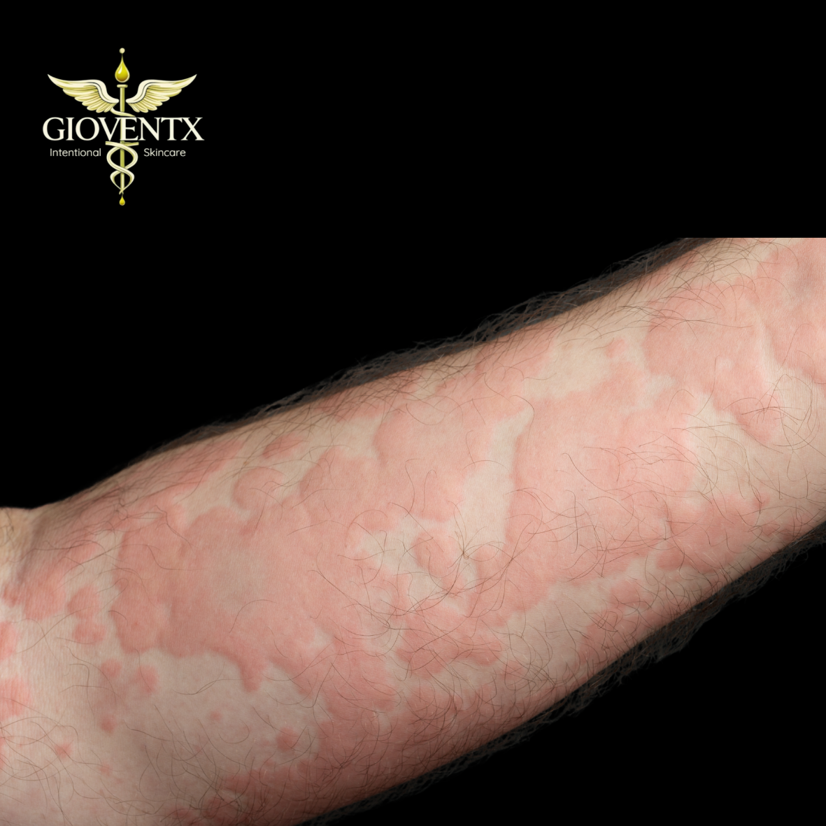 Allergic Reactions vs. Irritation